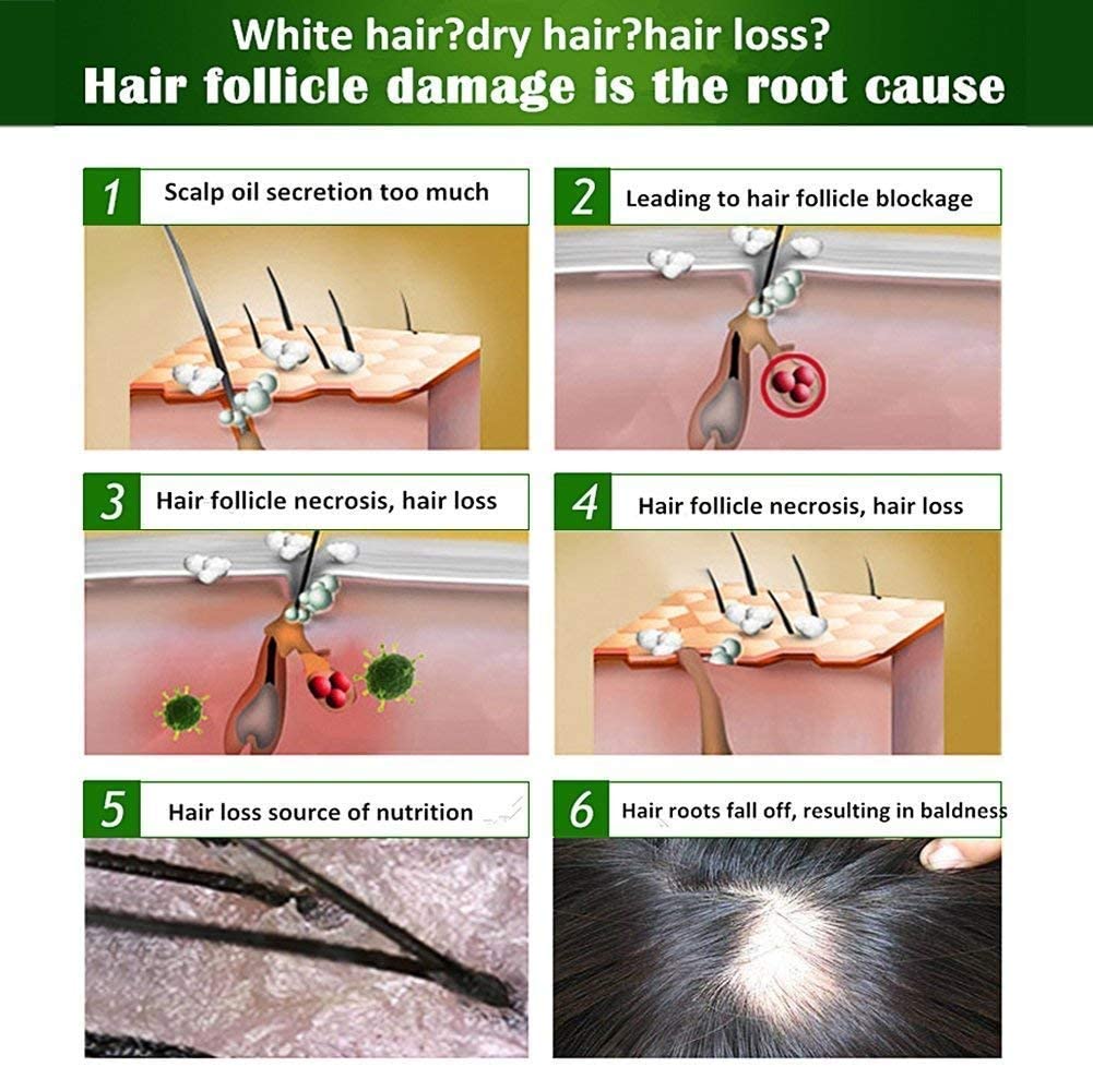  Sérum de crecimiento del cabello, tratamiento para el cabello y fortalece los folículos para el crecimiento del cabello, ayuda al crecimiento del cabello. 