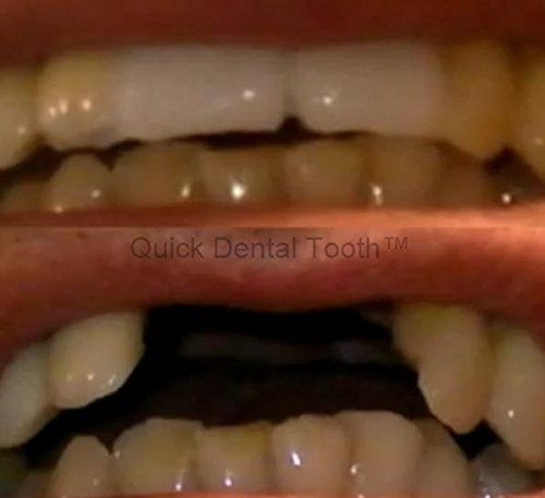 Prótesis dental temporal Quick Dental Tooth TM